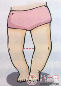 寶寶羅圈腿怎么矯正 怎么判斷是不是羅圈腿