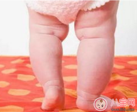 寶寶羅圈腿怎么矯正 怎么判斷是不是羅圈腿