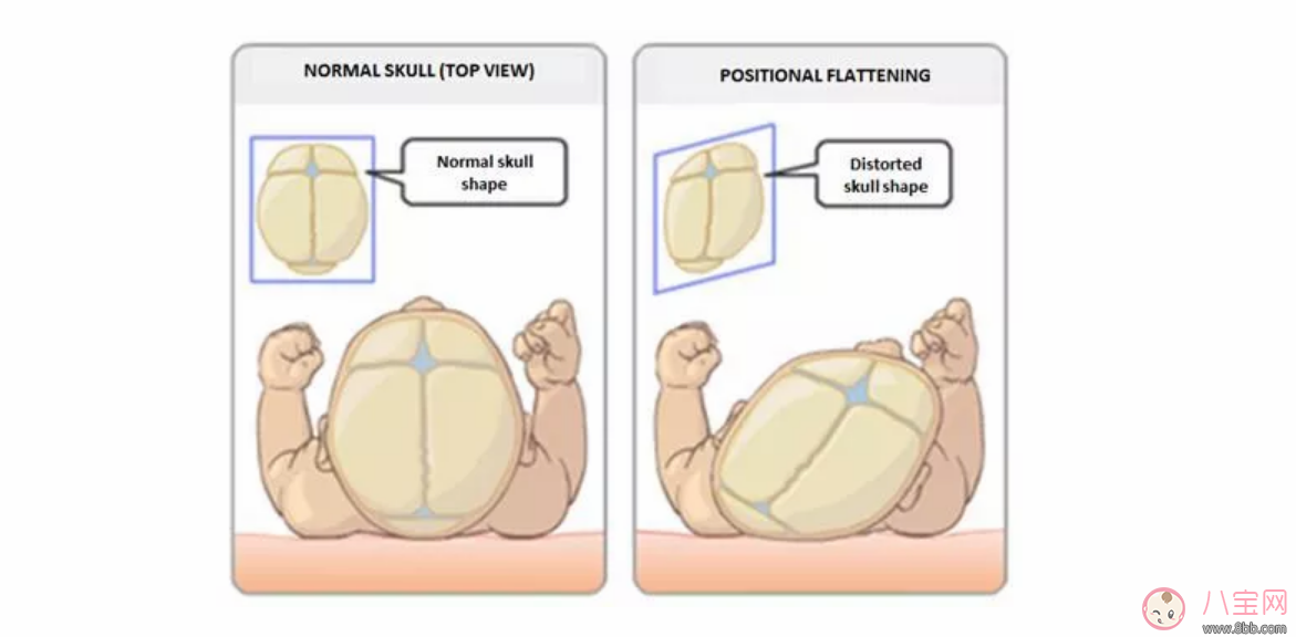 寶寶睡偏頭用定型枕有用嗎 寶寶睡偏頭了怎么糾正