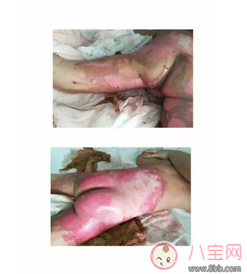 濟南小太陽幼兒園燙傷孩子事件 濟南小太陽幼兒園地址