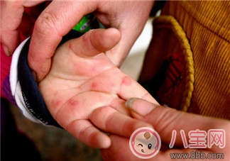 手足口病會傳染嗎 手足口病是不是傳染病