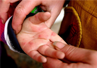 手足口病臉上會起疹子嗎 手足口病有哪些癥狀