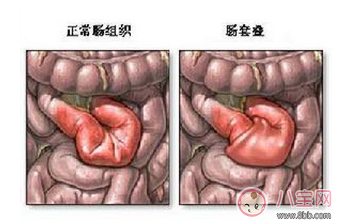 寶寶腸套疊是怎么引起的 腸套疊需要?jiǎng)邮中g(shù)嗎 寶寶腸套疊是怎么引起的 腸套疊需要?jiǎng)邮中g(shù)嗎