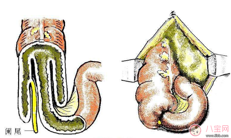 寶寶腸套疊是怎么引起的 腸套疊需要?jiǎng)邮中g(shù)嗎 寶寶腸套疊是怎么引起的 腸套疊需要?jiǎng)邮中g(shù)嗎