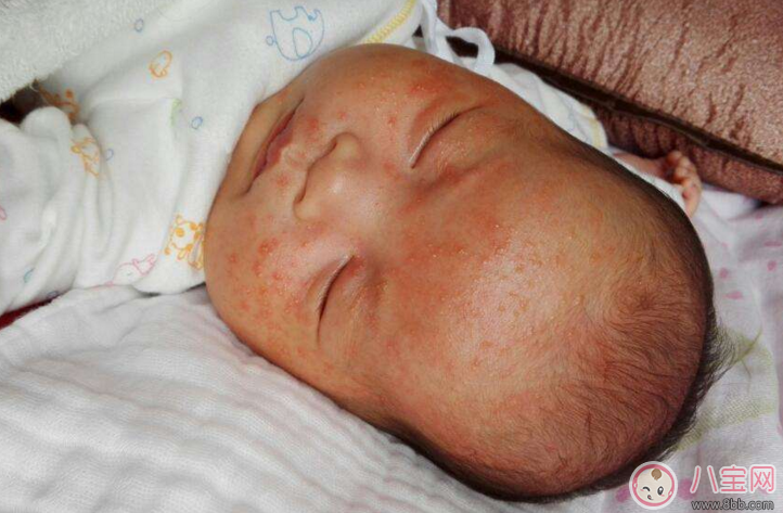 寶寶濕疹反復發(fā)作怎么辦 濕疹為什么會反復發(fā)作 寶寶濕疹反復發(fā)作怎么辦 濕疹為什么會反復發(fā)作
