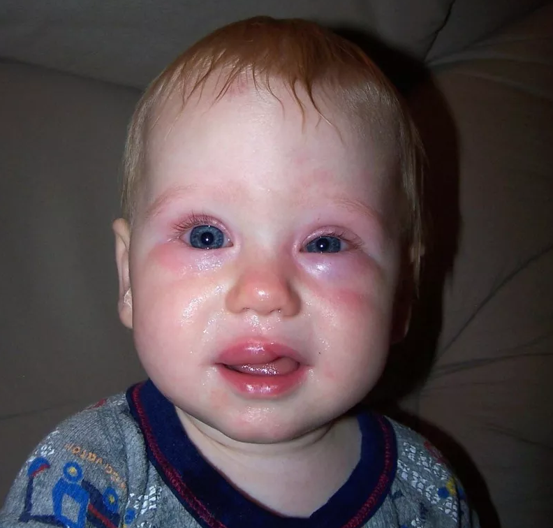 孩子吃芒果過敏怎么辦 怎么知道孩子吃芒果過不過敏2018