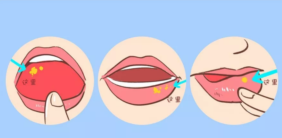 孕婦口腔潰瘍怎么辦 孕期口腔潰瘍如何治療