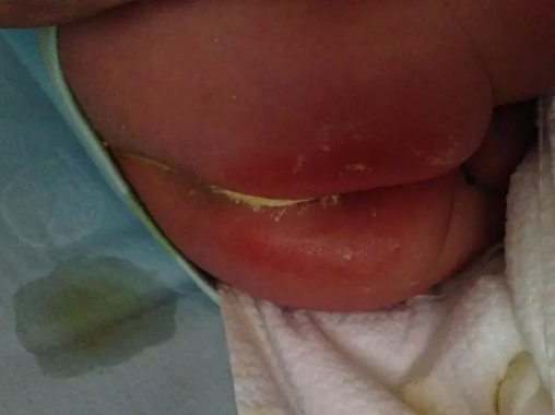 寶寶尿布疹是什么樣子的 孩子尿布疹怎么護理治療2018