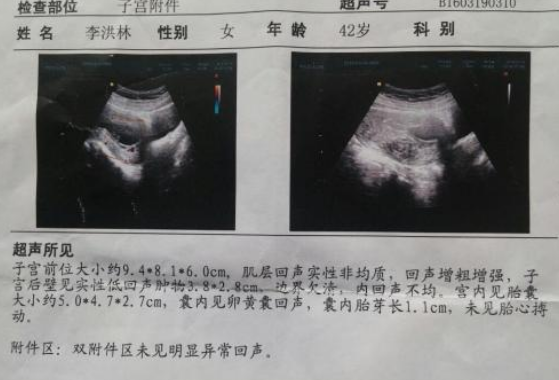 胎停育后能成功保胎嗎2018 有胎停育保胎成功經(jīng)驗(yàn)嗎 胎停育后能成功保胎嗎2018 有胎停育保胎成功經(jīng)驗(yàn)嗎