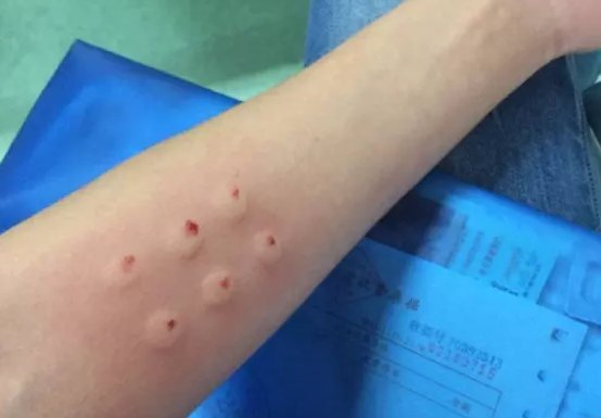 兩次胎停育第三次成功生男孩 胎停育做封閉抗體治療經(jīng)驗(yàn)