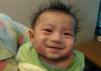 孩子濕疹會導(dǎo)致哮喘嗎 孩子濕疹怎么預(yù)防比較好2018 孩子濕疹會導(dǎo)致哮喘嗎 孩子濕疹怎么預(yù)防比較好2018