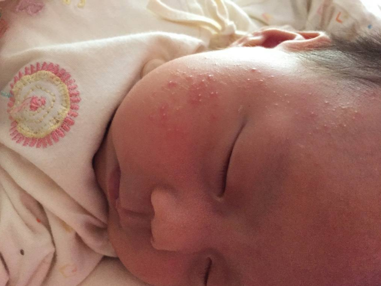 孩子濕疹會導(dǎo)致哮喘嗎 孩子濕疹怎么預(yù)防比較好2018 孩子濕疹會導(dǎo)致哮喘嗎 孩子濕疹怎么預(yù)防比較好2018