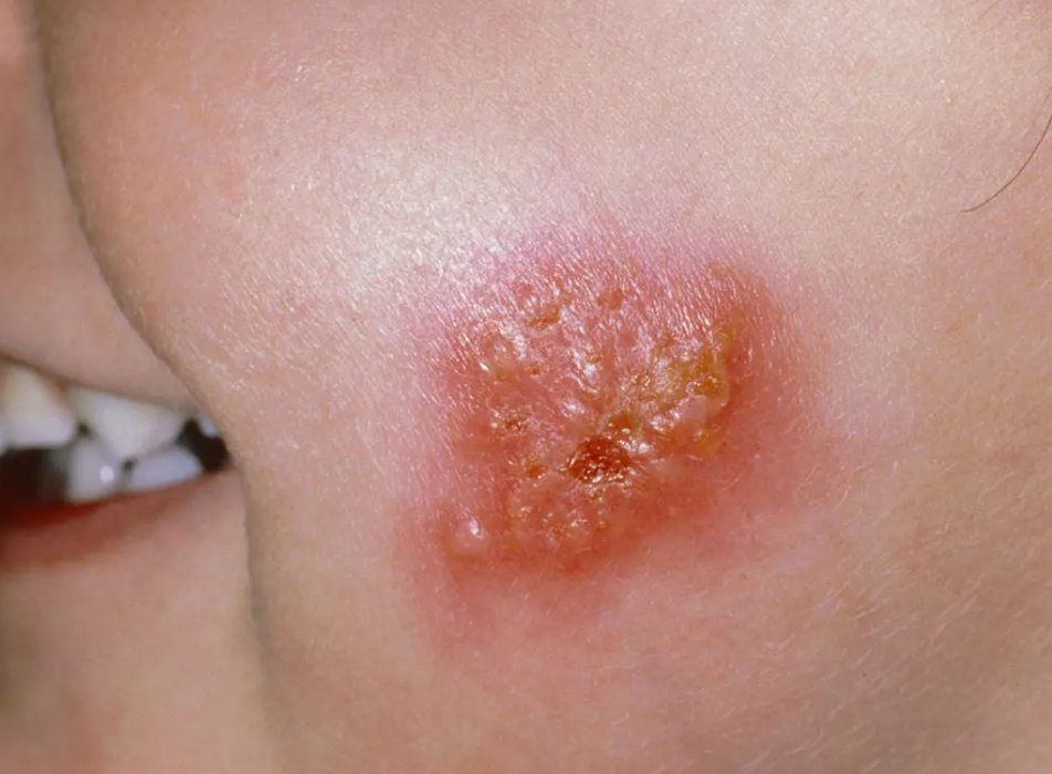 怎么分辨嬰兒的皮膚問題 如何快速區分寶寶皮膚病 