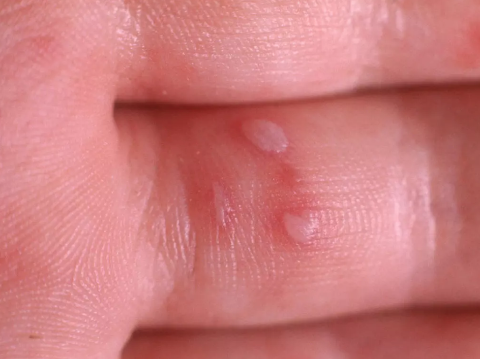 怎么分辨嬰兒的皮膚問題 如何快速區分寶寶皮膚病 