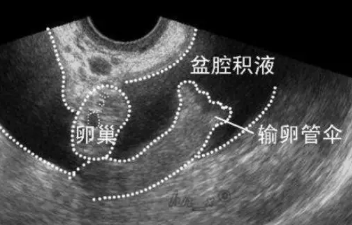 盆腔積液反反復復怎么辦2018 盆腔積液是從哪里來的