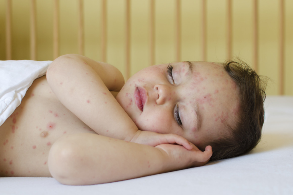 寶寶被蟲咬了起水泡怎么辦 2018夏季寶寶蟲咬皮炎如何處理 寶寶被蟲咬了起水泡怎么辦 2018夏季寶寶蟲咬皮炎如何處理