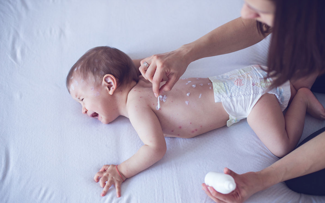 寶寶被蟲咬了起水泡怎么辦 2018夏季寶寶蟲咬皮炎如何處理 寶寶被蟲咬了起水泡怎么辦 2018夏季寶寶蟲咬皮炎如何處理