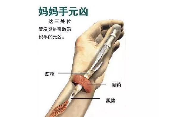 熊黛林媽媽手是什么 媽媽手怎么治療2018
