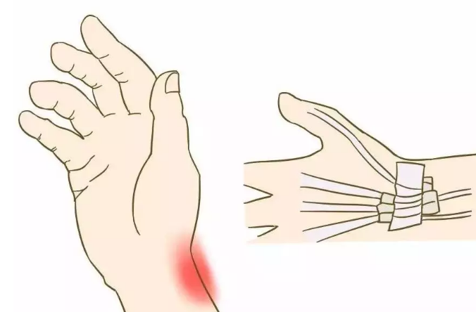 媽媽手腱鞘炎吃什么藥好 媽媽手腱鞘炎怎么治療2018