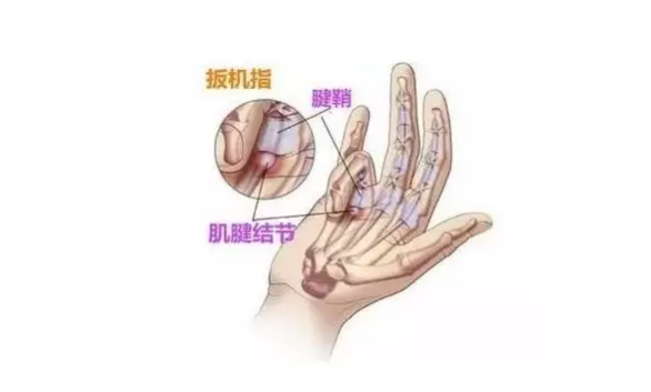 媽媽手腱鞘炎吃什么藥好 媽媽手腱鞘炎怎么治療2018