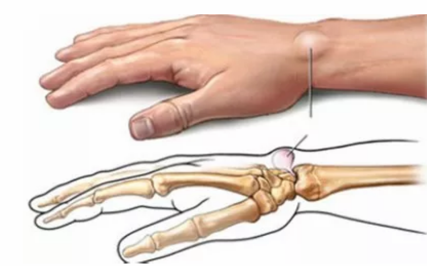 哪些習慣容易患媽媽手 媽媽手腱鞘炎怎么治療 哪些習慣容易患媽媽手 媽媽手腱鞘炎怎么治療