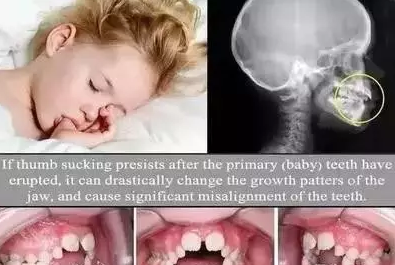 孩子喜歡吃手會變丑嗎 孩子喜歡吃手怎么做比較好2018