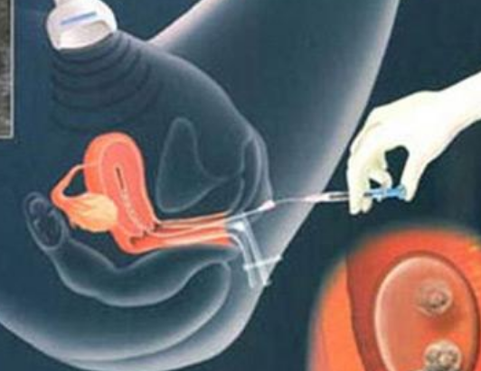 做試管嬰兒會誘發腫瘤嗎2018 子宮肌瘤可以做試管嬰兒嗎