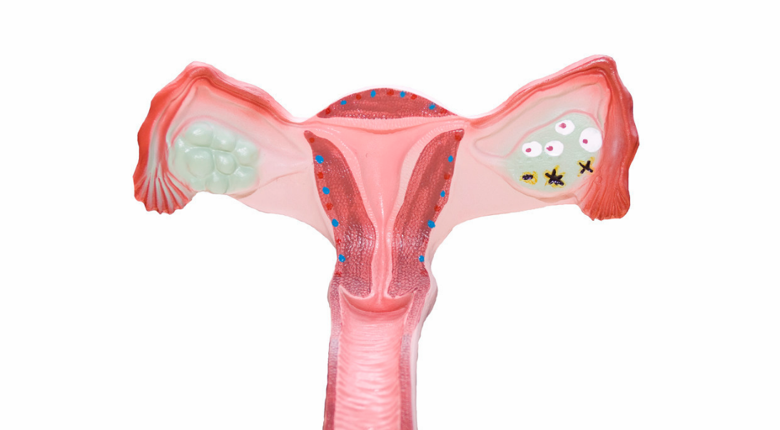 子宮后傾會(huì)造成哪些不適 如何改善子宮后傾