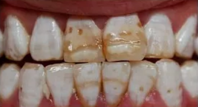 孩子用含氟牙膏會導(dǎo)致氟斑牙嗎 3歲以下的孩子有必要用含氟牙膏嗎 孩子用含氟牙膏會導(dǎo)致氟斑牙嗎 3歲以下的孩子有必要用含氟牙膏嗎