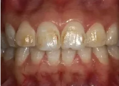 孩子刷牙齒不能用含氟牙膏嗎 孩子用含氟牙膏會(huì)變成氟斑牙嗎