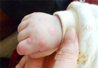 手足口病不吃藥能自愈嗎 手足口病多久可以自愈