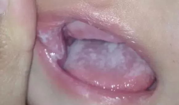 孩子口里有白點是鵝口瘡嗎 孩子鵝口瘡有哪些癥狀2018 孩子口里有白點是鵝口瘡嗎 孩子鵝口瘡有哪些癥狀2018
