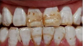 孩子刷牙齒不能用含氟牙膏嗎 孩子用含氟牙膏會(huì)變成氟斑牙嗎