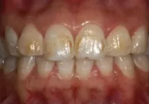 孩子用含氟牙膏會導(dǎo)致氟斑牙嗎 3歲以下的孩子有必要用含氟牙膏嗎 孩子用含氟牙膏會導(dǎo)致氟斑牙嗎 3歲以下的孩子有必要用含氟牙膏嗎