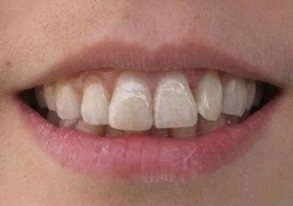 孩子用含氟牙膏會導(dǎo)致氟斑牙嗎 3歲以下的孩子有必要用含氟牙膏嗎 孩子用含氟牙膏會導(dǎo)致氟斑牙嗎 3歲以下的孩子有必要用含氟牙膏嗎