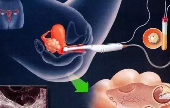 試管嬰兒長方案是什么 試管嬰兒長針長方案及短針長方案