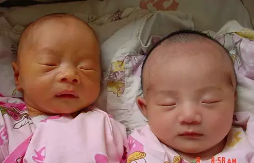 寶寶生理性和病理性黃疸有什么區別 生理性和病理性黃疸對比2018