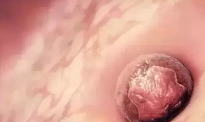子宮內(nèi)膜薄能讓受精卵著床嗎 試管嬰兒子宮內(nèi)膜薄怎么辦