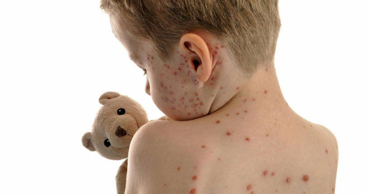 幼兒手足口病怎么鑒別輕重癥 寶寶手足口病會自愈嗎