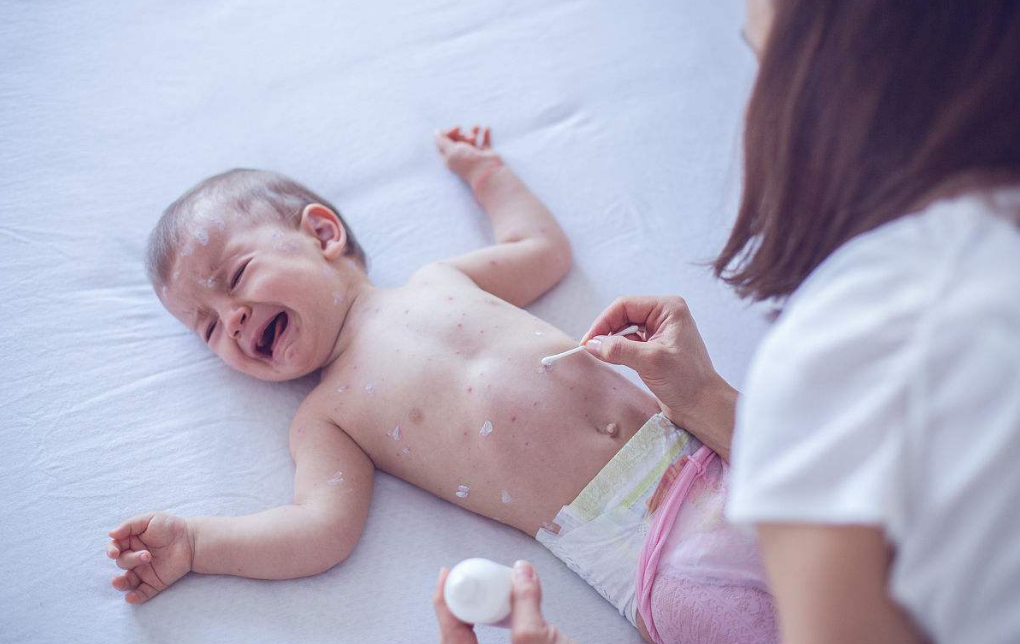 寶寶全身發(fā)紅怎么回事 寶寶容易過敏是遺傳嗎