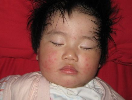 ?孩子起風疹是什么引起的 孩子風疹消退方法2018