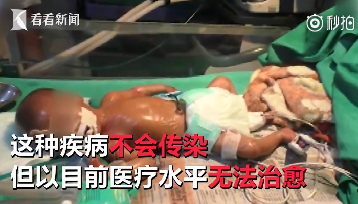 印度出現塑料嬰兒和環境有關嗎 印度塑料嬰兒能活多久 印度出現塑料嬰兒和環境有關嗎 印度塑料嬰兒能活多久