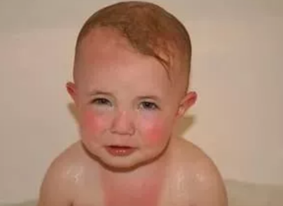 夏天寶寶曬傷怎么辦 寶寶怎么預防曬傷