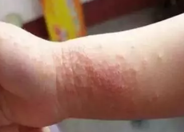 夏天寶寶接觸性皮炎怎么辦 寶寶接觸性皮炎預防方法