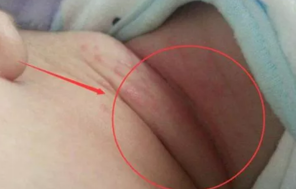 夏天寶寶間擦疹怎么辦 寶寶間擦疹預防方法