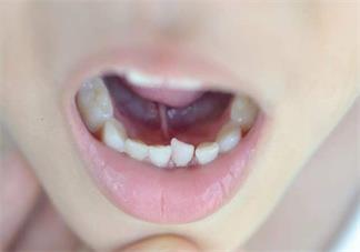 懷孕牙疼可以吃藥嗎 懷孕牙疼可以忍著嗎2018