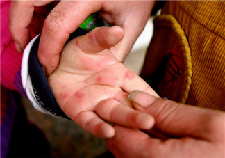 為什么手足口病后指甲會脫落 手足口病指甲脫落多久能長出新甲