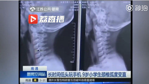 男孩頸椎變直線是怎么回事 小孩玩手機頸椎變直線真的嗎