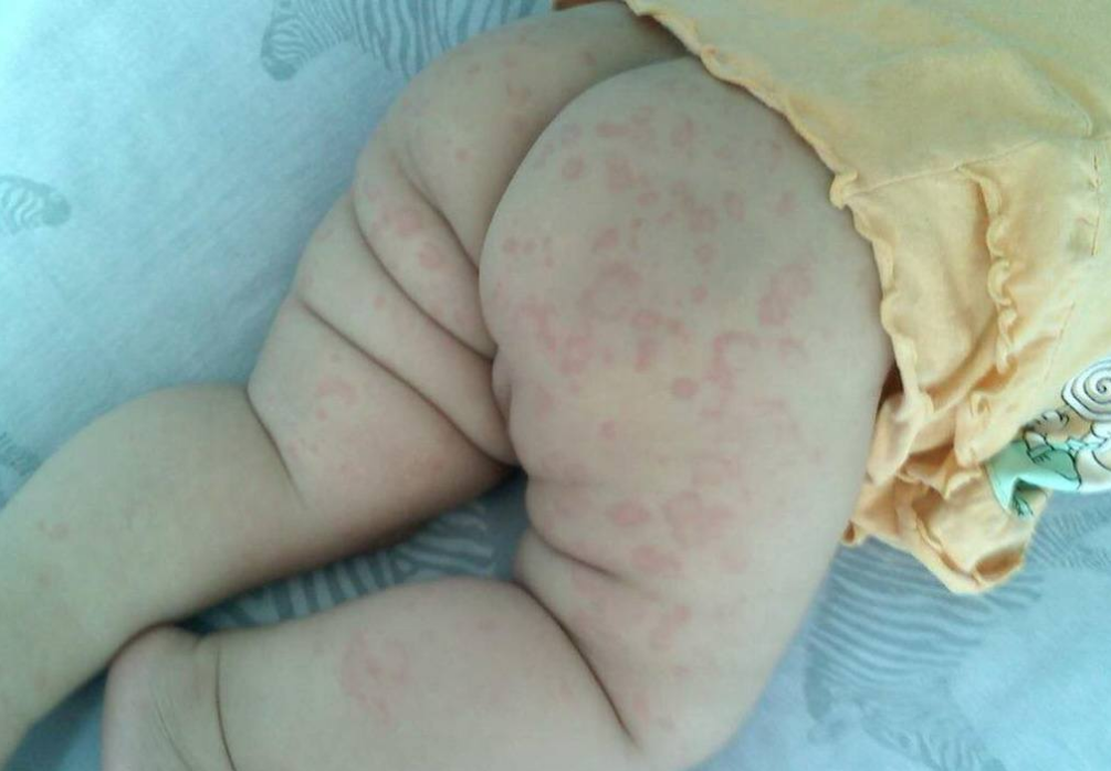 怎么判斷孩子是否對牛奶過敏 牛奶過敏的嬰兒怎么吃好