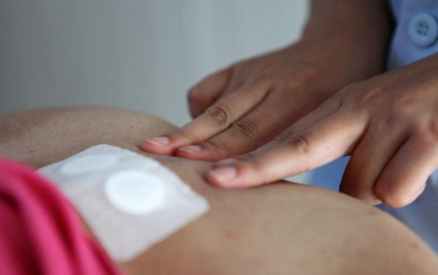 貼三伏貼能不能治療過敏 2018冬病夏治三伏貼有用嗎